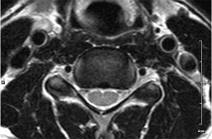 頸椎MRI画像
