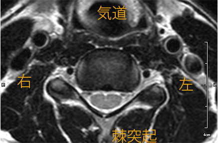 頸椎MRIのイメージ画像