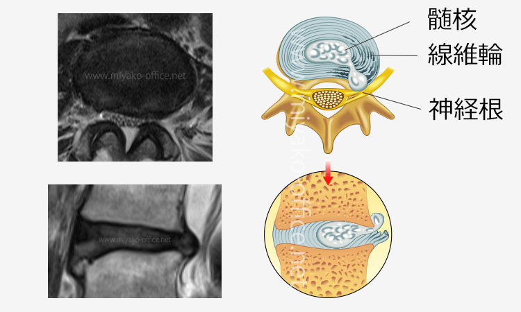 椎間板ヘルニアの仕組み